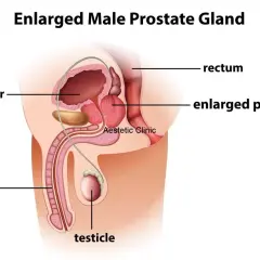 Urolog od czego? Ilustracja przedstawia powiększoną prostatę, pęcherz, cewkę moczową, prącie i jądro.