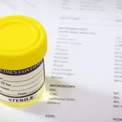 Pojemnik na mocz obok wydruku analizy, gdzie ciężar właściwy moczu wynosi 1,005. Wyniki badań laboratoryjnych.