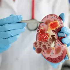 Lekarz w niebieskich rękawiczkach wskazuje na model nerki z widocznymi zmianami, sugerującymi kamicę nerkową.