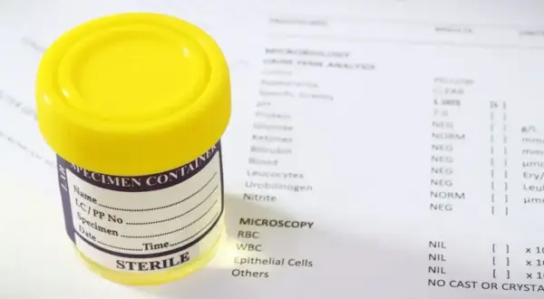 Pojemnik na mocz obok wydruku analizy, gdzie ciężar właściwy moczu wynosi 1,005. Wyniki badań laboratoryjnych.
