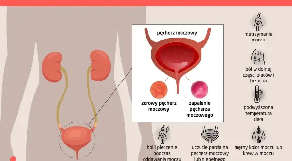 Objawy zapalenia pęcherza moczowego: ból, pieczenie, nietrzymanie moczu, gorączka. Jak leczyć? Ilustracja pokazuje układ moczowy i objawy.