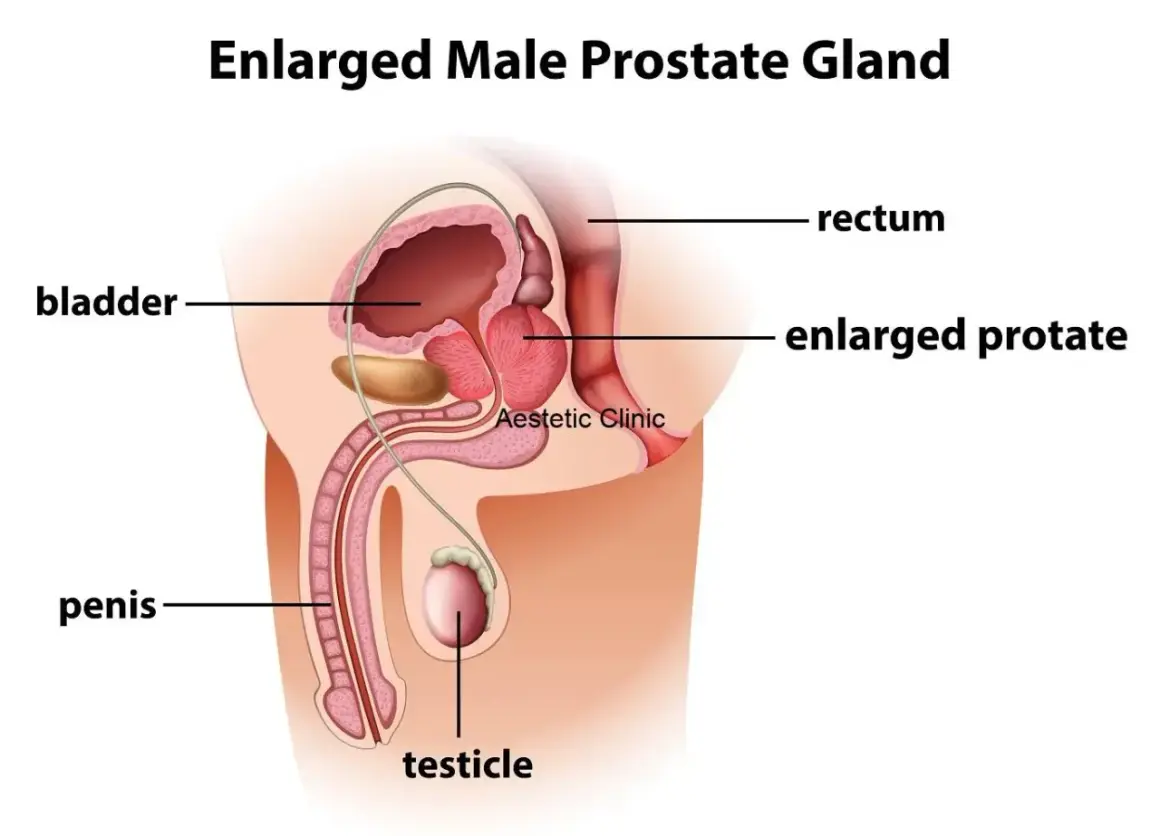 Urolog od czego? Ilustracja przedstawia powiększoną prostatę, pęcherz, cewkę moczową, prącie i jądro.