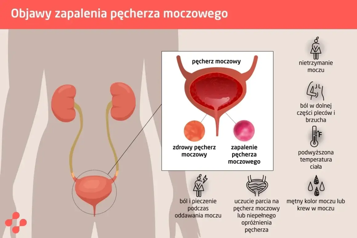 Objawy zapalenia pęcherza moczowego: ból, pieczenie, nietrzymanie moczu, gorączka. Jak leczyć? Ilustracja pokazuje układ moczowy i objawy.