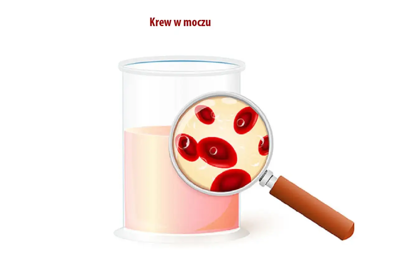Krew w moczu, widoczna pod lupą, może być objawem guza pęcherza moczowego.