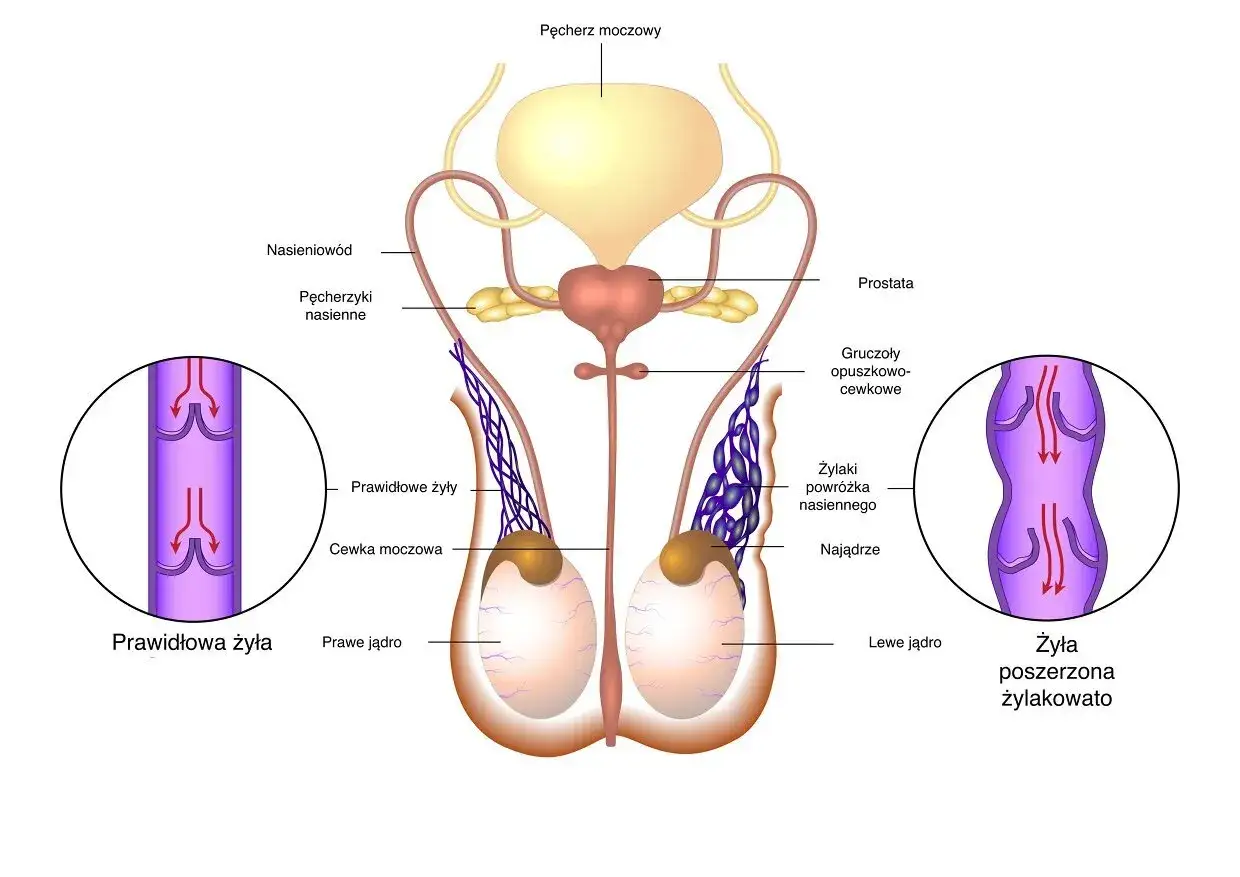 Anatomia męskiego układu rozrodczego z zaznaczonymi żylakami powrózka nasiennego, które mogą prowadzić do nieleczonego wodniaka jądra.