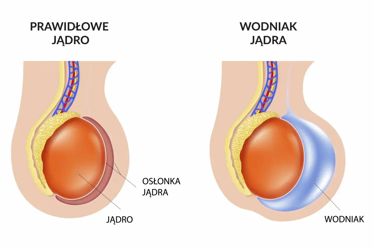 Porównanie prawidłowego jądra z jądrem z nieleczonym wodniakiem. Wodniak to nagromadzenie płynu w mosznie.