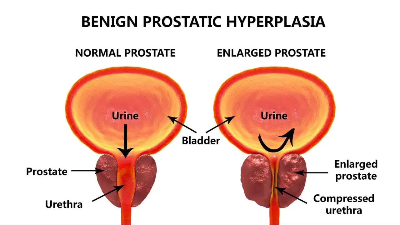 Ilustracja pokazuje, jak powiększona prostata powoduje problem z oddawaniem moczu, uciskając cewkę moczową.